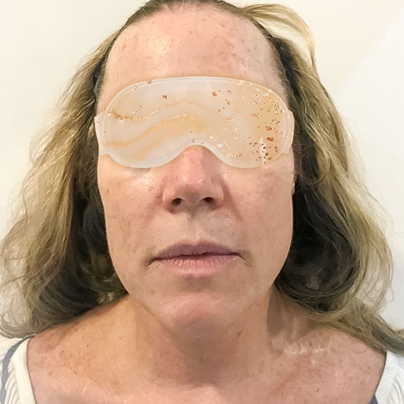 Despues Ultherapy
